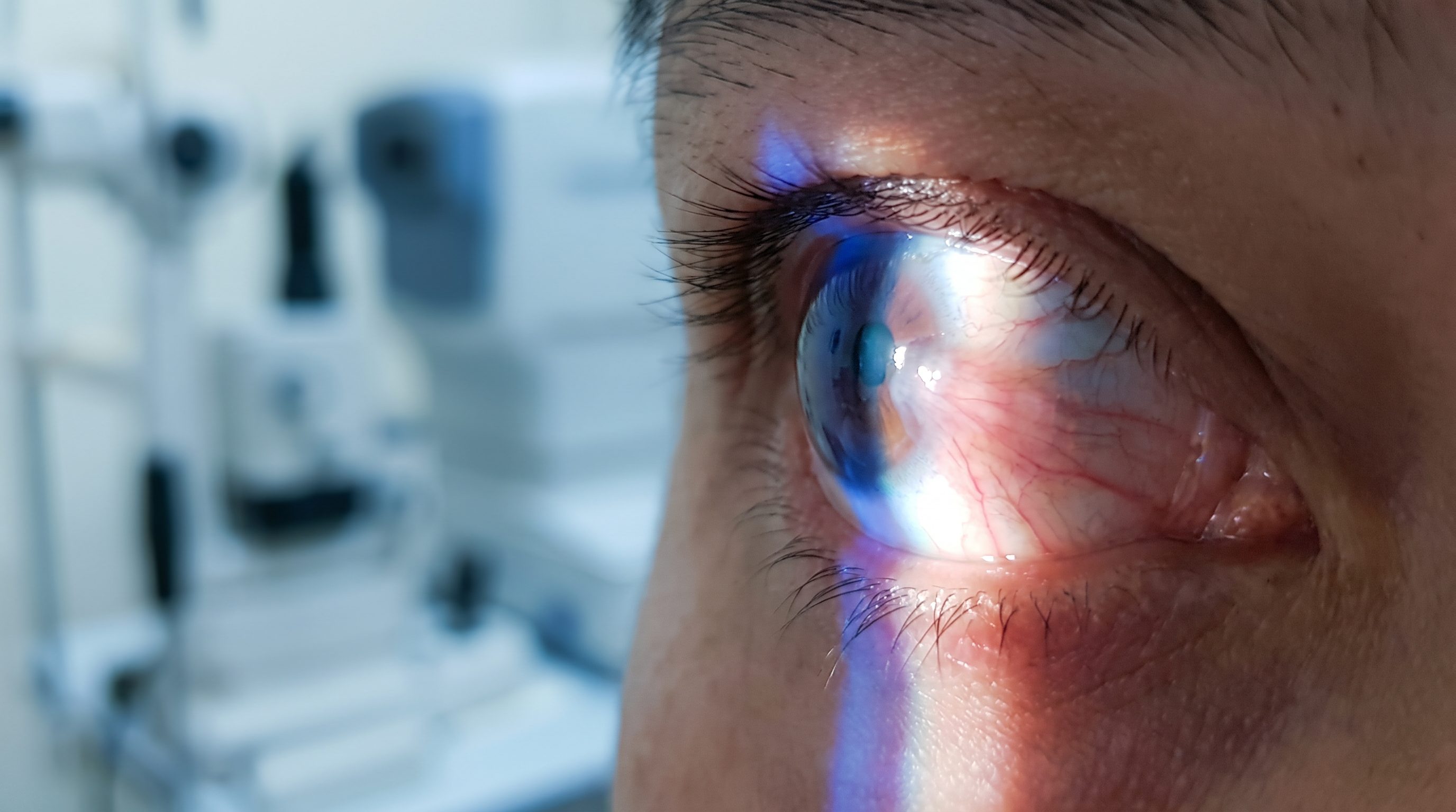 Cirurgia de Pterígio com transplante conjuntival — Dr. Cláudio Vieira