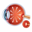 Ilustração de Glaucoma