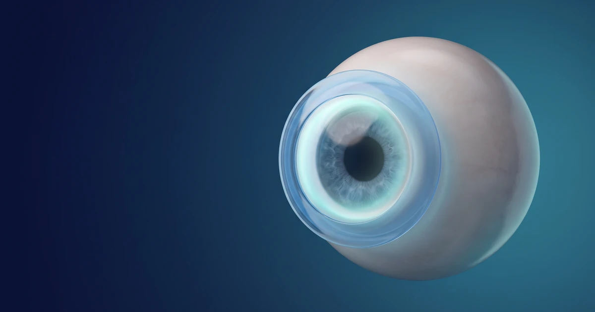 Ilustração 3D de transplante de córnea com enxerto circular translúcido em olho humano